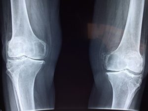 Radiographie d'un genou