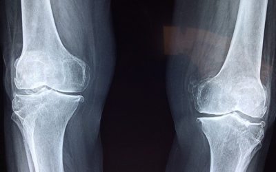 Arthrose du genou : l’ostéopathie peut-elle aider ?